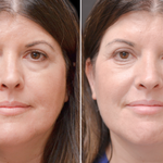 BotoxLux™ Creme Lifting com Peptídeos