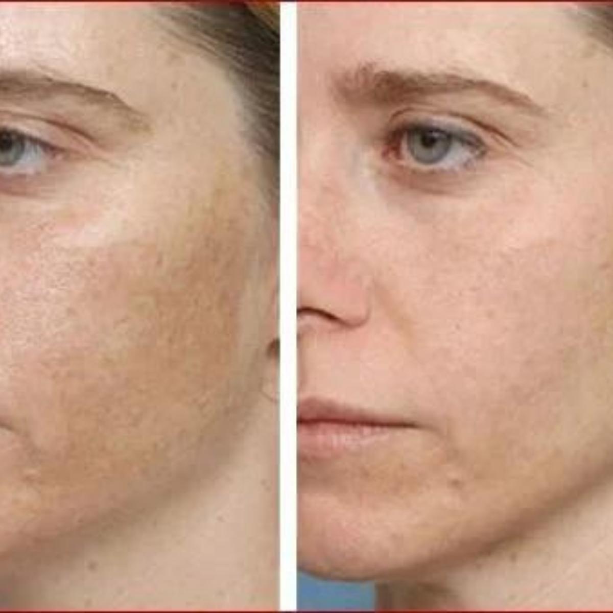 Aparelho Peeling Ultrassônico Limpeza Facial – Pele Radiante - Saúde no Cotidiano