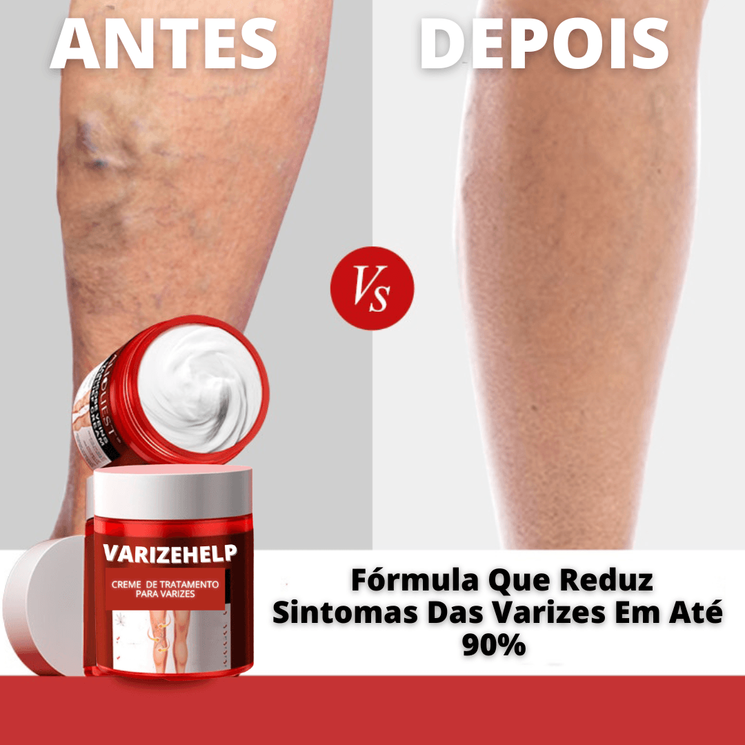 Creme Para Varizes Efeito Imediato VarizeHelp – Saúde no Cotidiano