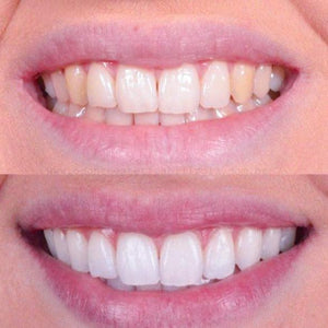 Clareador Dental Sorriso Max - Saúde no Cotidiano